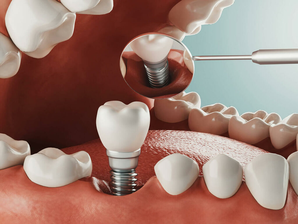 digital mockup of a bottom tooth getting an implant