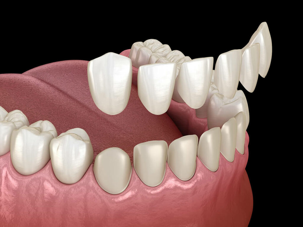 digital mockup of a bottom row of teeth receiving dental veneers