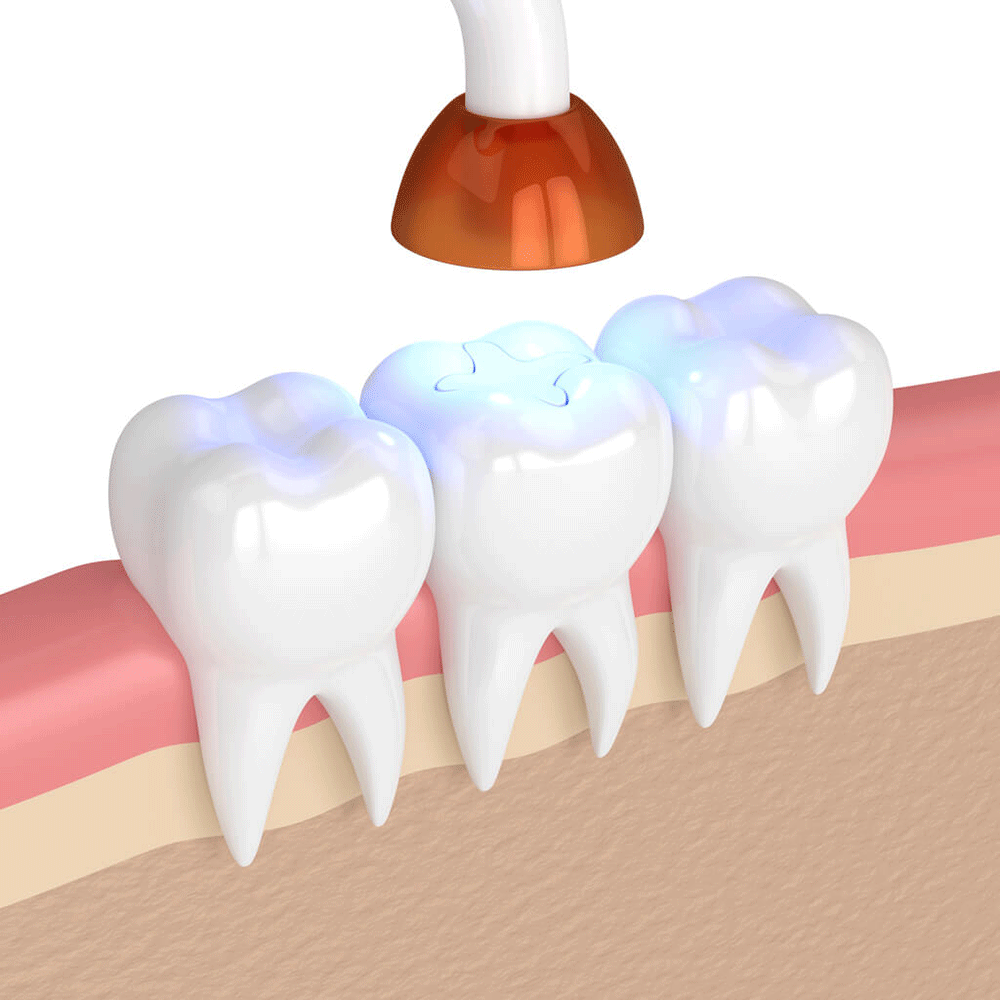 digital visual of a tooth receiving a dental filling