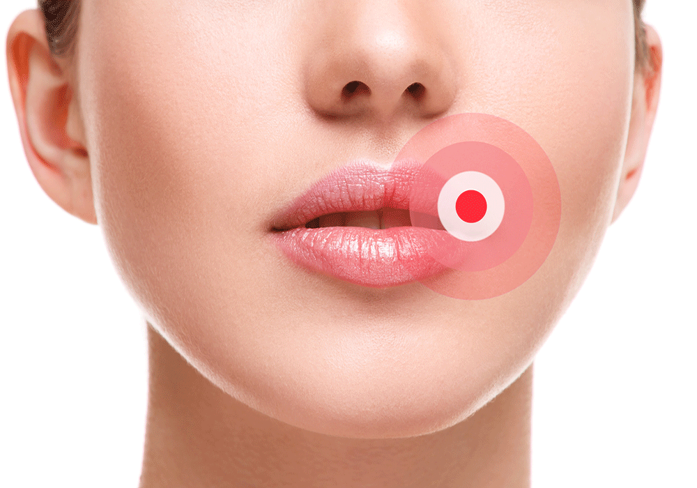close up of a woman's face with a red dot, a visual representation of a cold sore, near the corner of her mouth