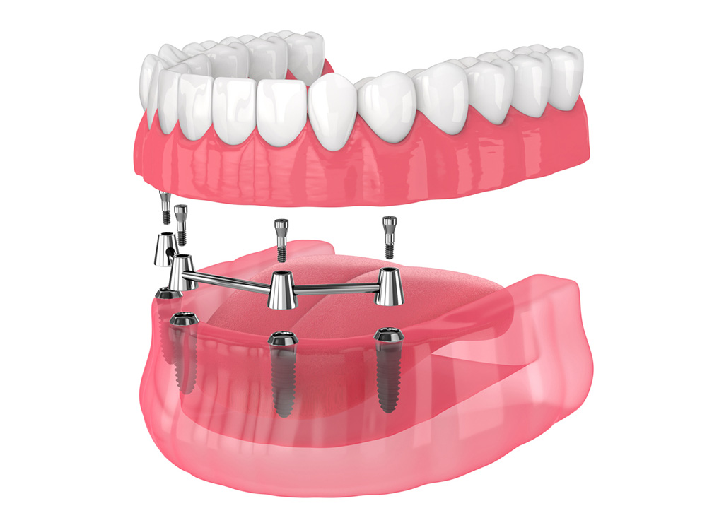 3D mockup of bottom row of teeth with all on four dental implants