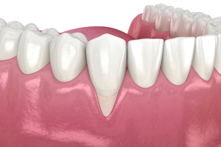 visual mockup of a bottom row of teeth suffering from gum recession