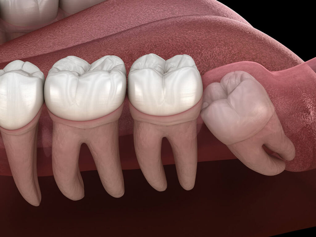 digital mockup of a bottom row of teeth when the wisdom tooth is impacted