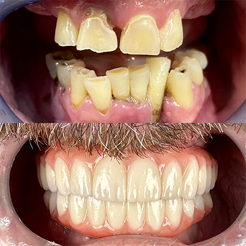 Fifth before and after comparison for hybrid dental implants in Nashville, TN