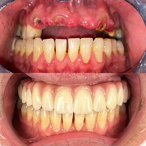 First before and after comparison for hybrid dental implants in Nashville, TN