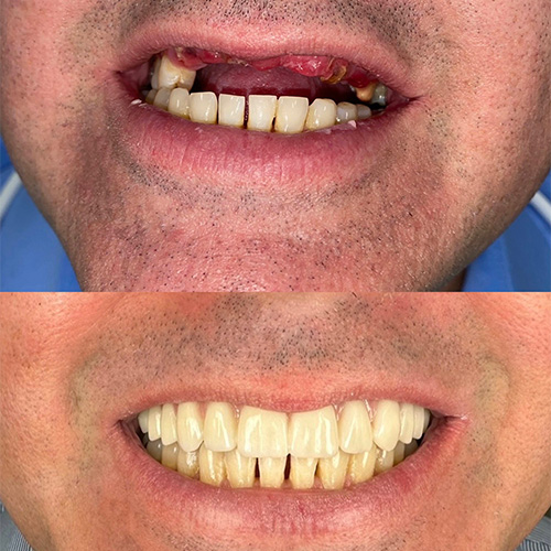 Second before and after comparison for hybrid dental implants in Nashville, TN