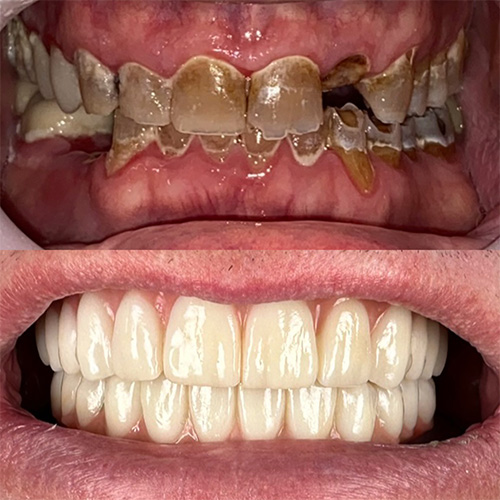 Third before and after comparison for hybrid dental implants in Nashville, TN