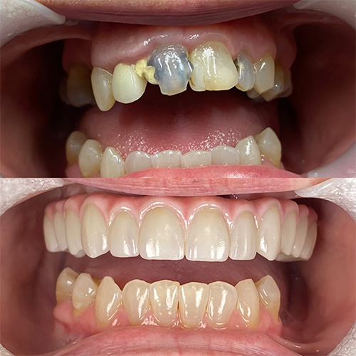 Fourth before and after comparison for hybrid dental implants in Nashville, TN